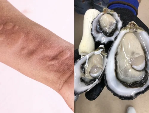 Dị ứng hàu biển: Dấu hiệu và cách xử lý khi ăn hàu bị dị ứng