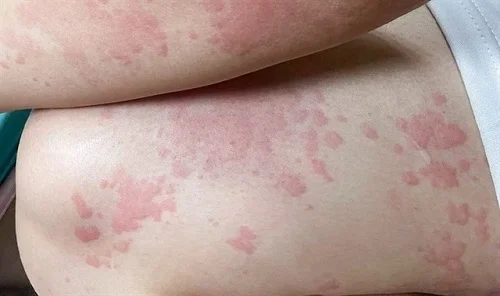 Dấu hiệu dị ứng với sầu riêng