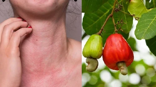 Dị ứng hạt điều: Dấu hiệu, cách chữa và phòng ngừa