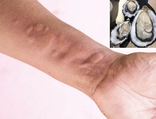 Những triệu chứng dị ứng hàu biển Triệu chứng dị ứng hàu biển