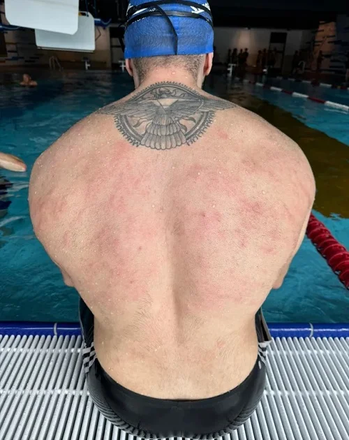 biểu hiện dị ứng nước hồ bơi