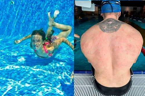 Dị ứng nước hồ bơi: Dấu hiệu, nguyên nhân và cách xử lý nhanh