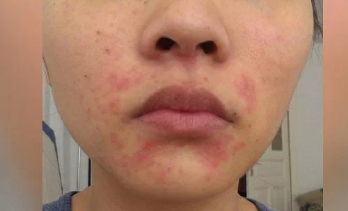 Dấu hiệu dị ứng vitamin C