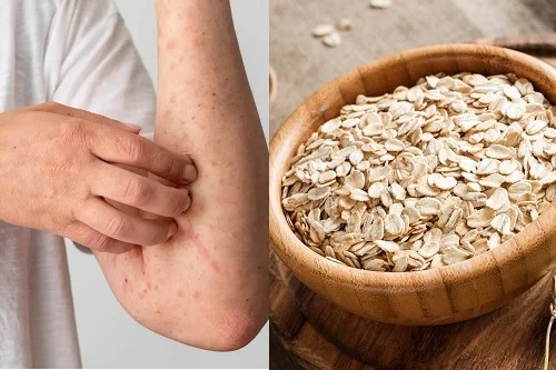 Biểu hiện dị ứng yến mạch và cách xử lý an toàn