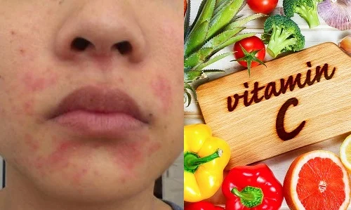 Những dấu hiệu dị ứng Vitamin C và cách xử lý, phòng tránh