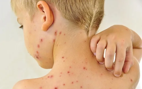 Tắm lá tre khi bị thuỷ đậu được không