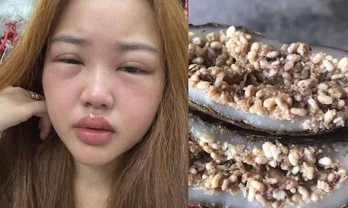 Dị Ứng Bánh Trứng Kiến: Dấu Hiệu Nhận Biết Và Hướng Xử Lý