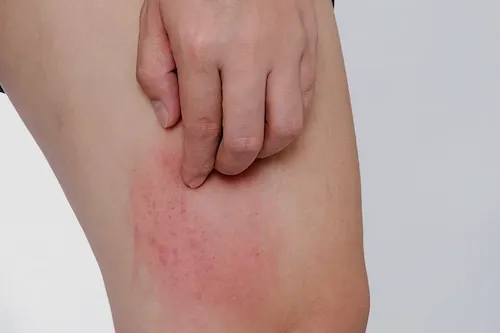 bị con dĩn đốt