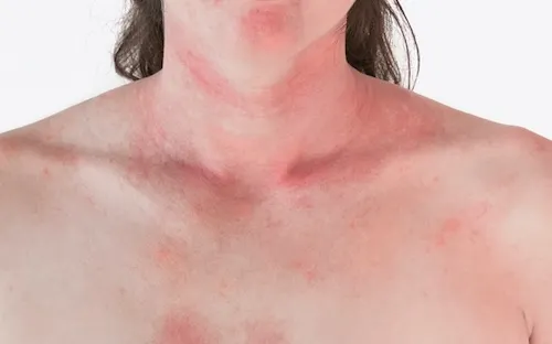 bị dĩn đốt sưng to