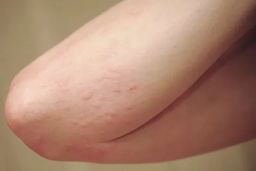 ăn ve sầu bị dị ứng