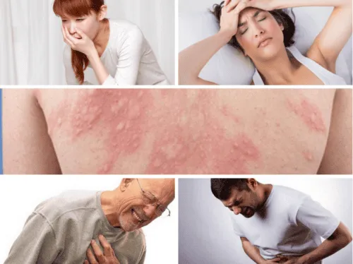 dị ứng chả rươi