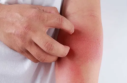 hoa ly có phấn hoa gây dị ứng