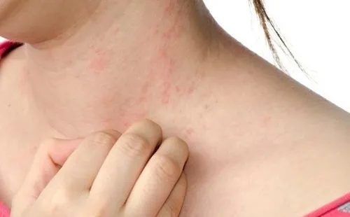 bị dị ứng mắm tôm
