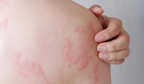 dị ứng ve sầu phải làm sao