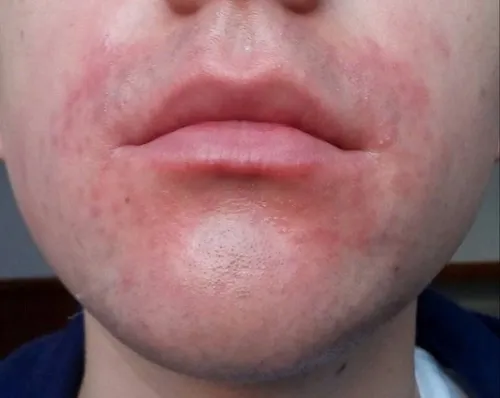 dị ứng nhựa xoài