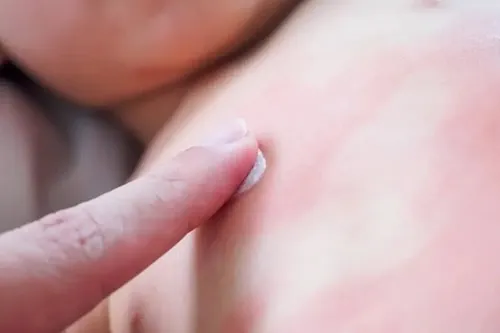 dị ứng sứa khi tắm biển