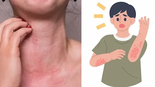 dị ứng sứa khi ăn