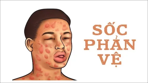 dị ứng với xoài