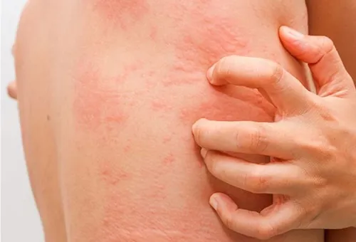 biểu hiện dị ứng lươn