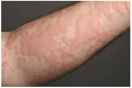 trẻ ăn lươn có bị dị ứng không