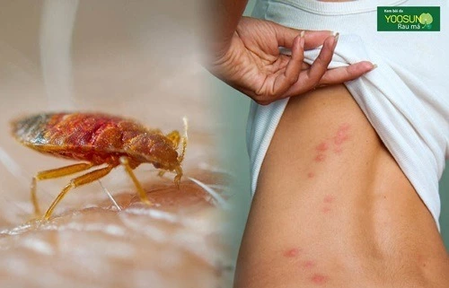 Rệp giường cắn: Nguyên nhân, dấu hiệu, xử lý từ A đến Z