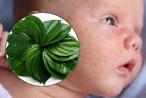 Cách chữa lác sữa bằng lá trầu không