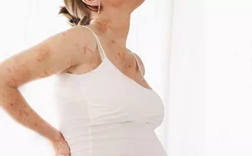 Nguyên nhân nổi rôm sảy ở bà bầu 