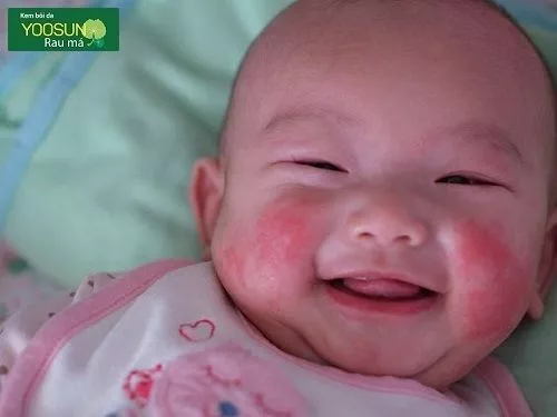 Bé bị chàm sữa là gì
