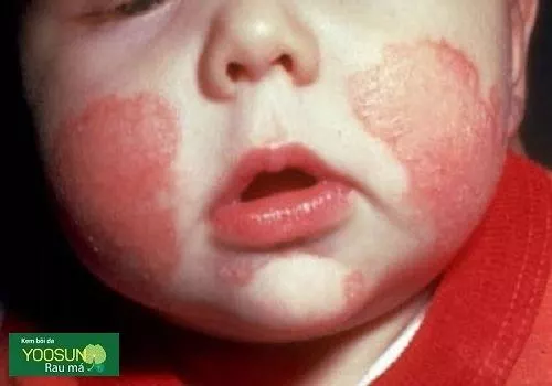 Bé bị lác sữa ở mặt