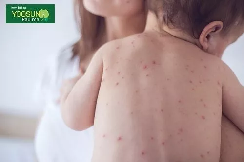 Bé bị nốt phỏng nước