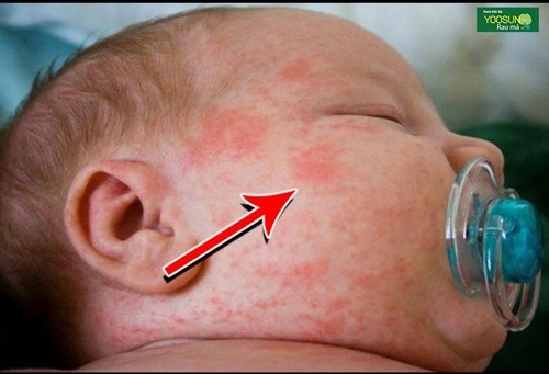 Bệnh lác sữa ở trẻ nhỏ