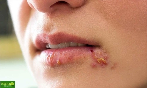 Bị chốc mép là bệnh gì