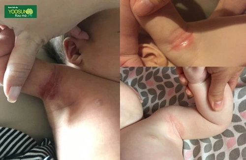 Bị hăm nách ở trẻ em