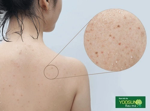 Bị mụn lưng có lây không