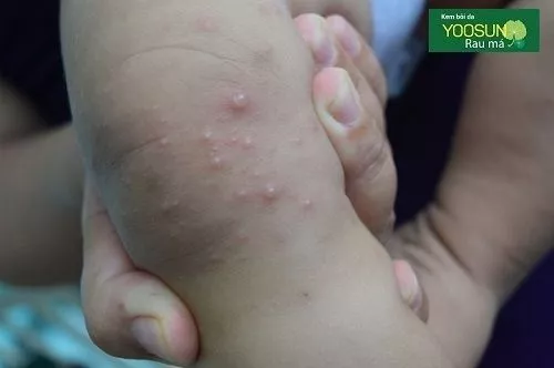 Cách điều trị mụn nước ở trẻ sơ sinh