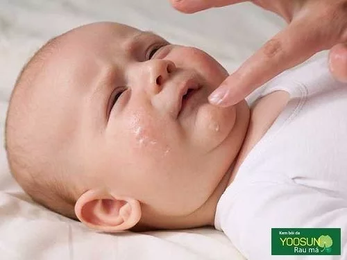Cách trị chàm sữa bôi hồ nước