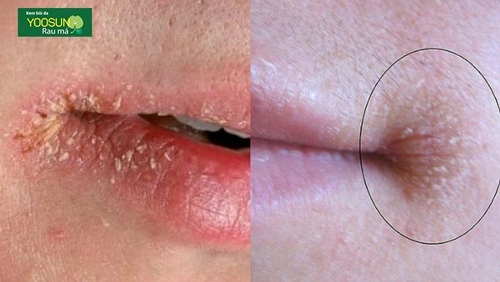 Dấu hiệu của tróc mép miệng