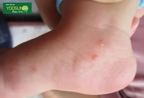 Hình ảnh mụn nước ở trẻ sơ sinh