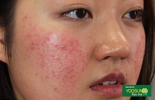 Hình ảnh viêm da tiếp xúc dị ứng ở mặt