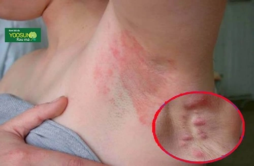 Người lớn bị hăm nách phải làm sao