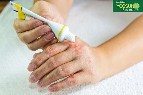 Thuốc chứa viêm da dị ứng tiếp xúc