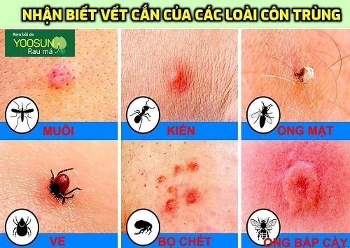 Trẻ bị nổi mụn nước khắp người