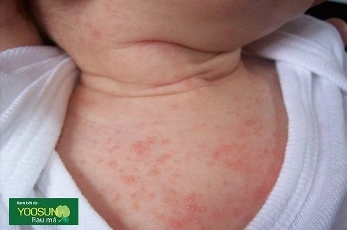 Trẻ em bị nổi mụn nước khắp người