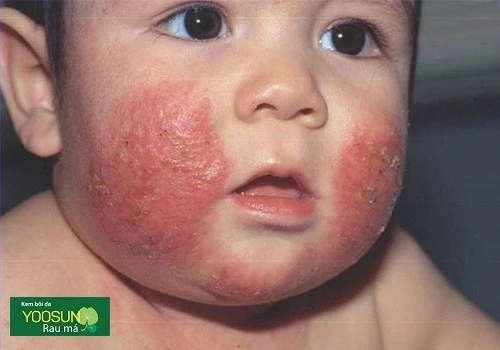 Trẻ sơ sinh bị mụn nước