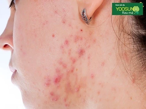Bị mụn ở cằm và quai hàm