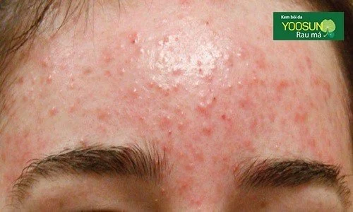Bị mụn ở trán nguyên nhân