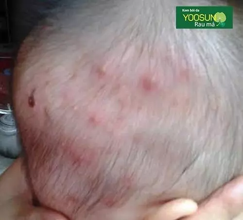 Bị nổi mụn bọc ở trẻ em
