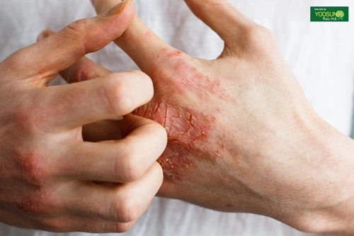 Bị viêm da tiếp xúc có ngưa không vậy? Bị viêm da tiếp xúc có ngưa không