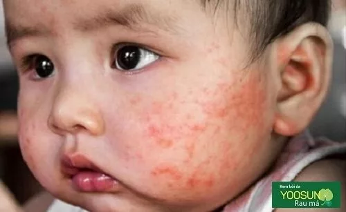 Bị viêm da tiếp xúc là gì? có ảnh hưởng gì không Bị viêm da tiếp xúc là gì