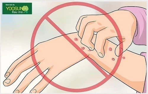 Bị viêm da tiếp xúc ở trẻ sơ sinh phải làm gì Bị viêm da tiếp xúc ở trẻ sơ sinh